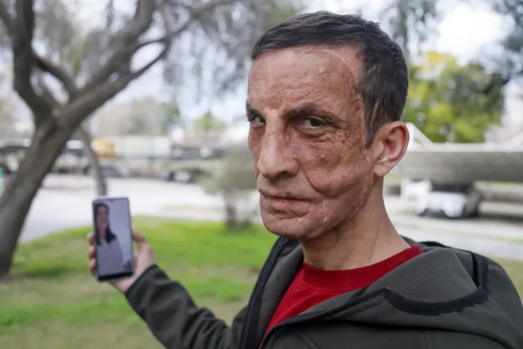 A touching meeting with Uğur, who received her father's face transplant